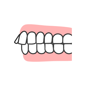 上顎前突のイラスト