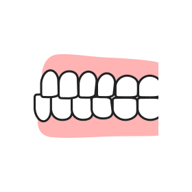 下顎前突のイラスト