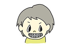 ワイヤー矯正の画像